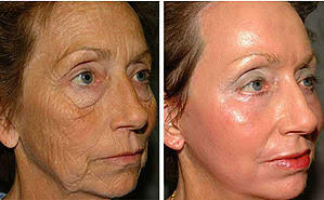 Deep chemical peel facial